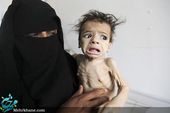 قحطی در یمن و سوءتغذیه کودکان+تصاویر