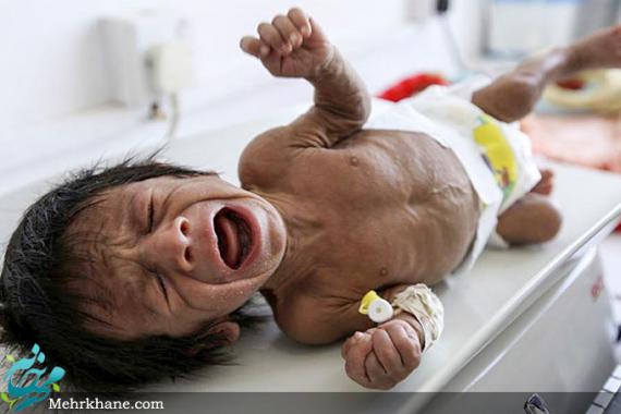 قحطی در یمن و سوءتغذیه کودکان+تصاویر